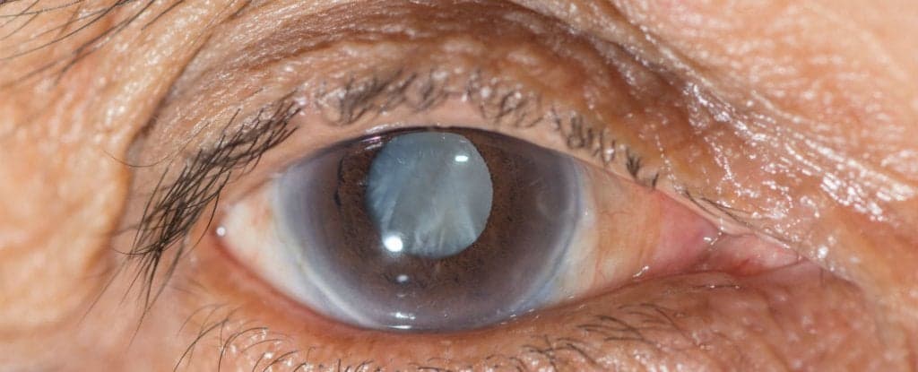 Scientists Develop Eye Drops That Could Cure Cataracts