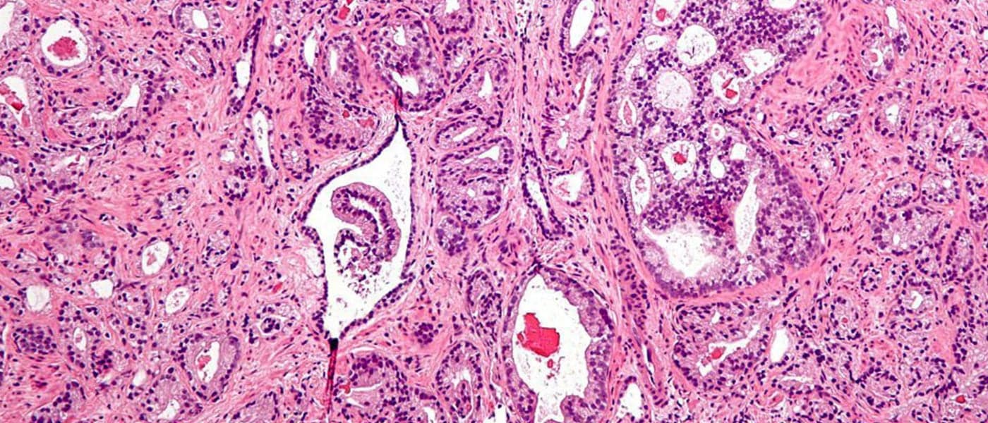 Scientists May Have Found a Better Way to Treat Prostate Cancer