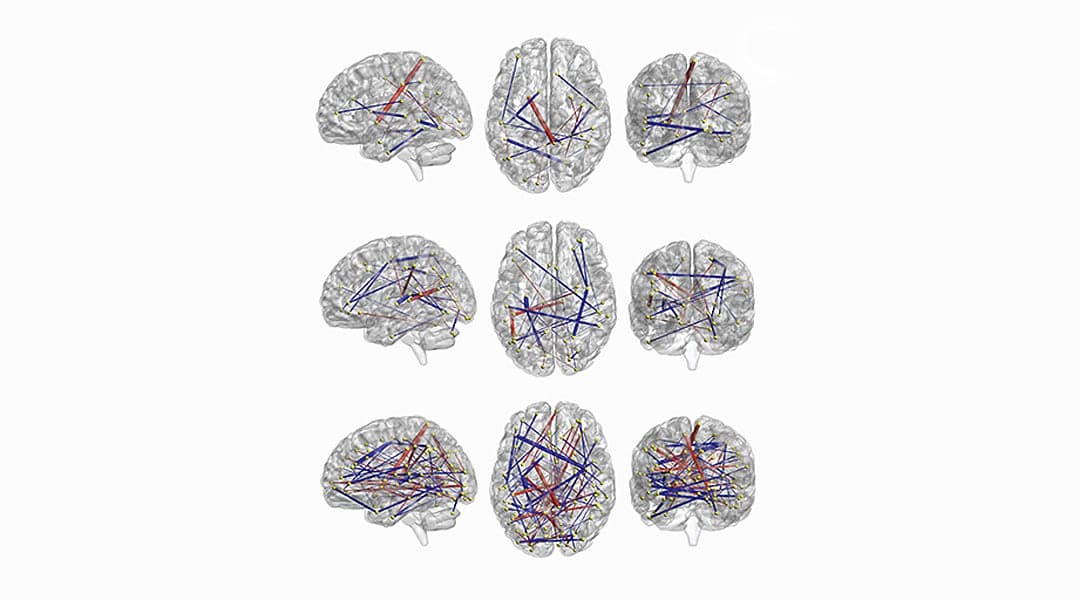 Emerson R.W. et al. Science Translational Mededicine