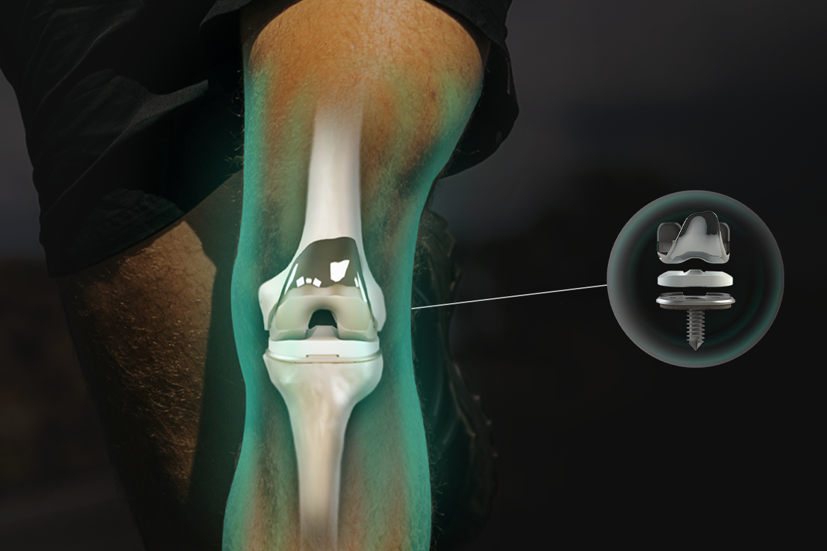 Invest in a New Knee Replacement Technology That Could Change Joint