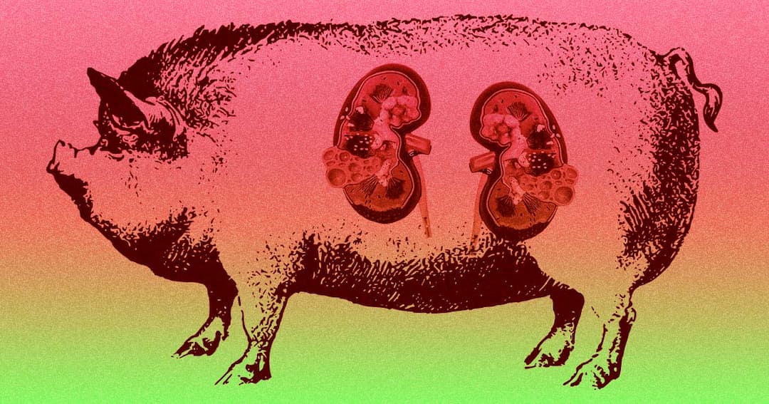 Doctors Successfully Transplant a Pig Kidney to a Human for First Time Ever