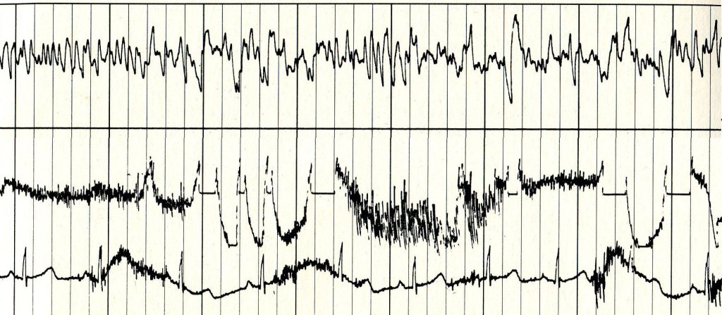 A sampling of Ann Druyan's brain waves, recorded on June 3, 1977.