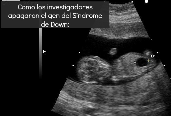 Ultrasound of fetus with Down syndrome and megacystis via X.Compagnion