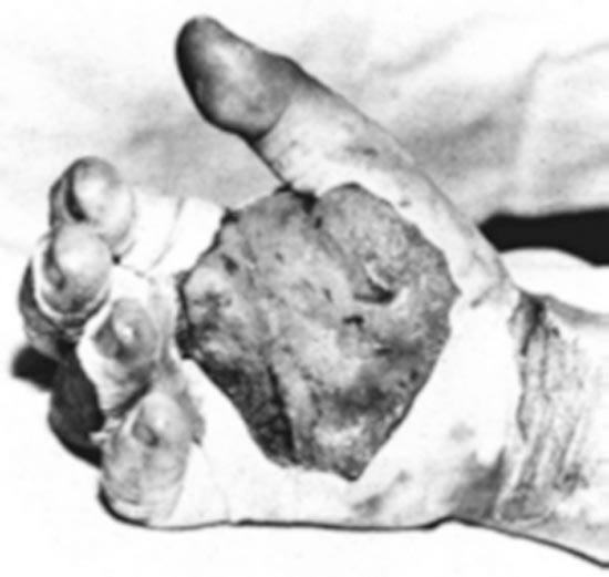 Daghlian's Hand some time after the initial exposure