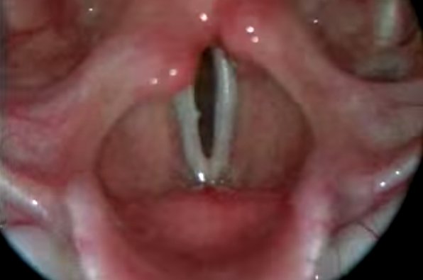 vocal cords