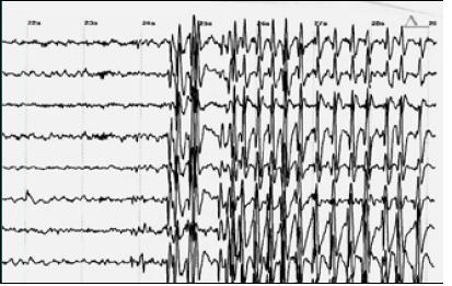 Revolutionary New Procedure For Epilepsy Diagnosis Unlocked By Research