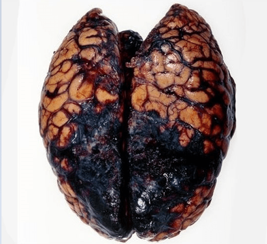 brain