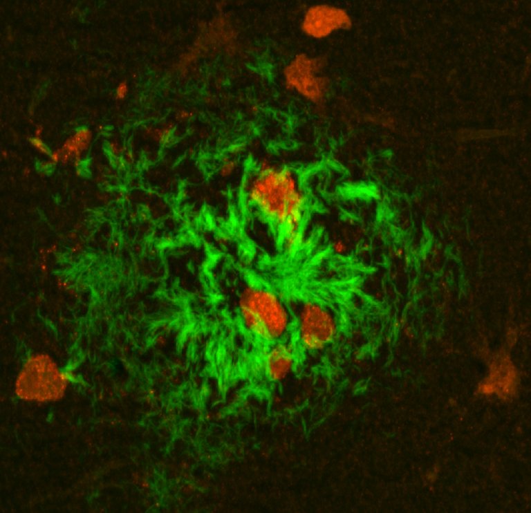 New Alzheimer’s Treatment Fully Restores Memory Function in 75% of Mice