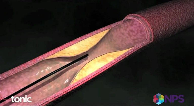 ‘Microswimmer’ robots to drill through blocked arteries within four years