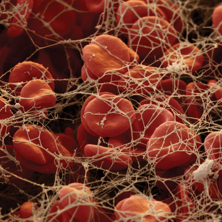 Researchers Create a Nanotech Device That Can Destroy Blood Clots