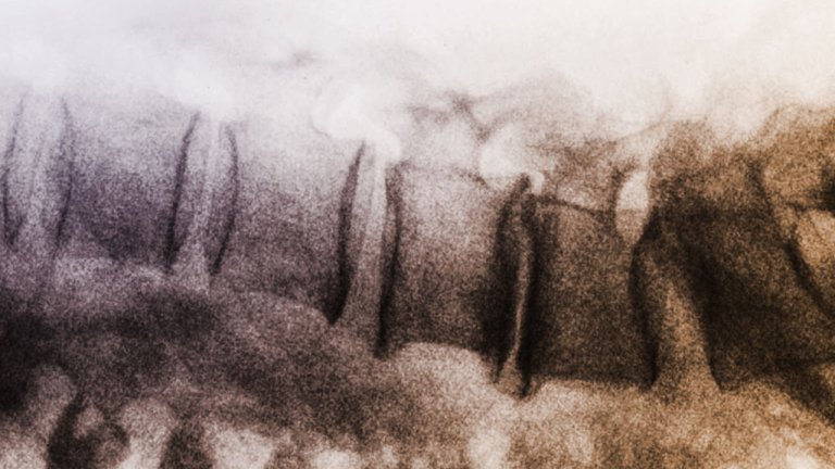 Computer program discovers latest breakthrough in spinal cord injuries