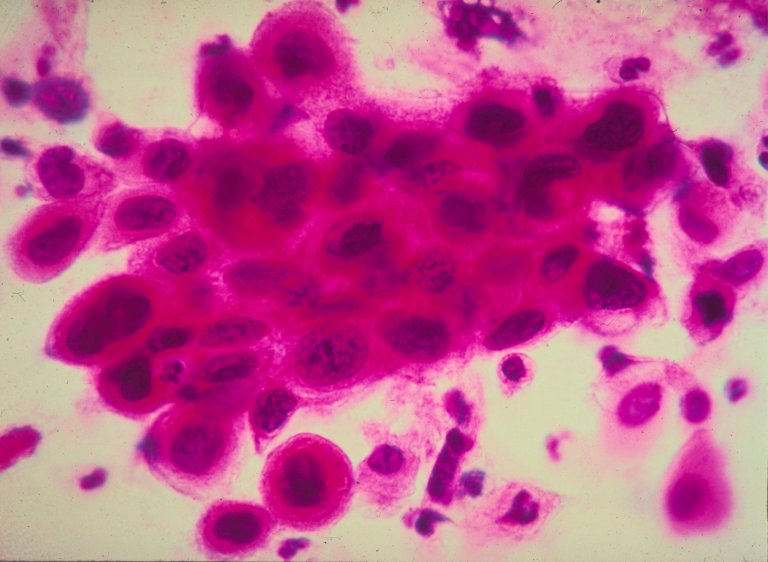 Nipping Cancer in the Bud—New Supersensitive Biosensor Makes It Happen