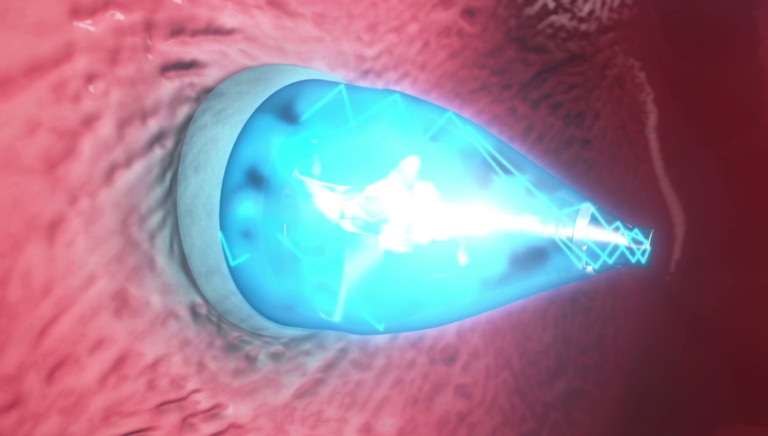 Fixing holes in the heart can now be done without invasive surgery