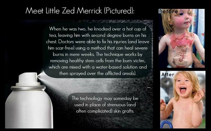 Treating Severe Burns in the 21st Century: Meet the Skin Cell Gun