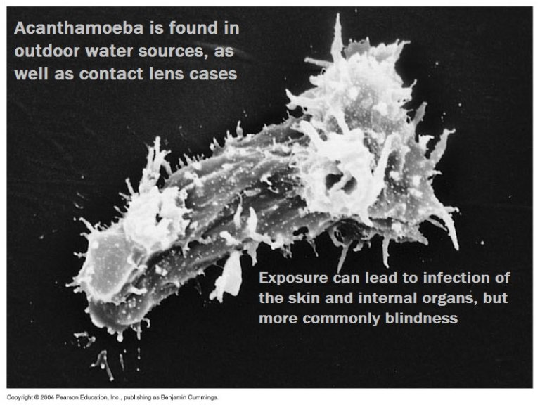 Acanthamoeba: Terror in the Eyes