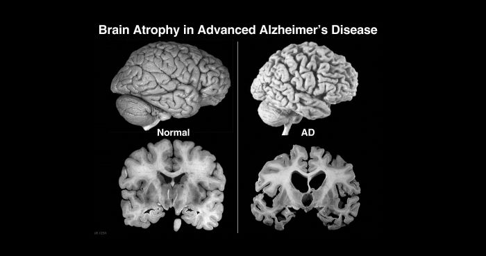 Research Shows New Alzheimer’s Treatment Fully Restores Memory Function