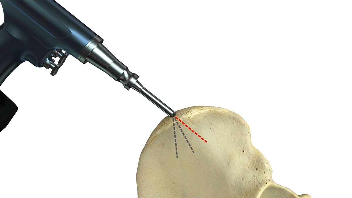 New Biodegradable Implant Could Enhance Bone Replacement Surgery