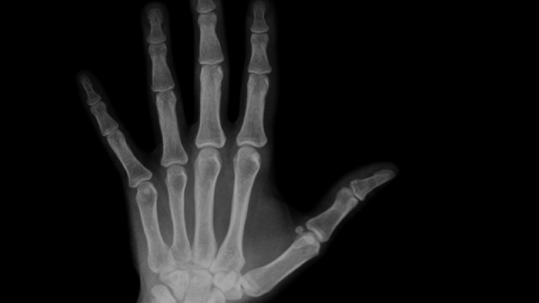 Watch: Here’s What Happens When You Crack Your Knuckles