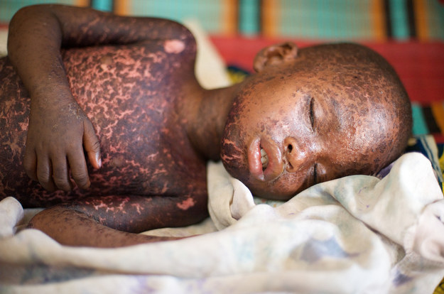 measles.jpg