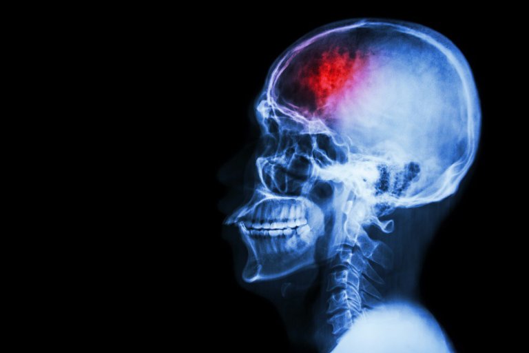 Magnetic Nanoparticles Could Stop Blood Clot-Caused Strokes