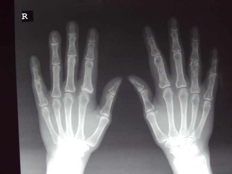 Scientists Invent Injectable Foam That Can Repair and Regrow Degenerating Bones