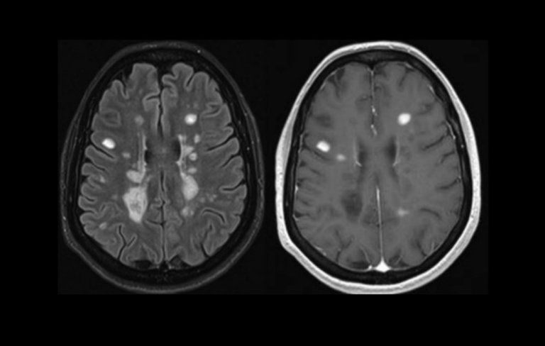 New Breakthrough Treatment Could “Reverse Disability” for MS Patients