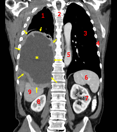 Malignant Mesothelioma, coronal CT scan/ Stevenfruitsmaak