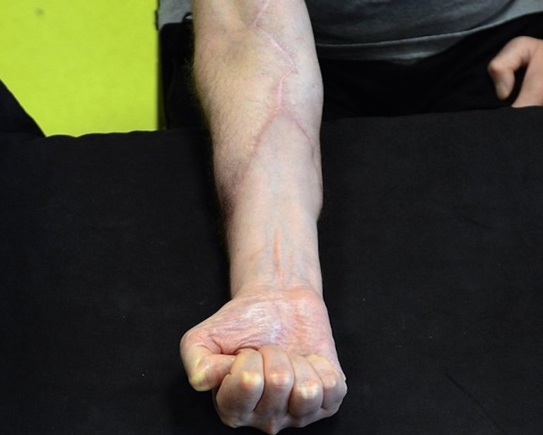 World First, Country to Offer Free Hand Transplants