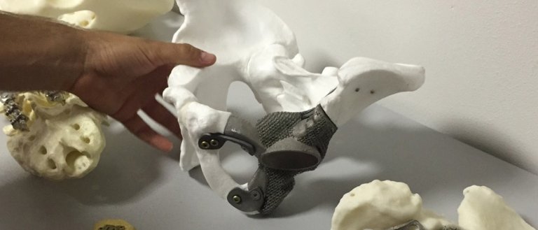 3D Printing Is Being Used to Make Prosthetic Bones for Cancer Patients