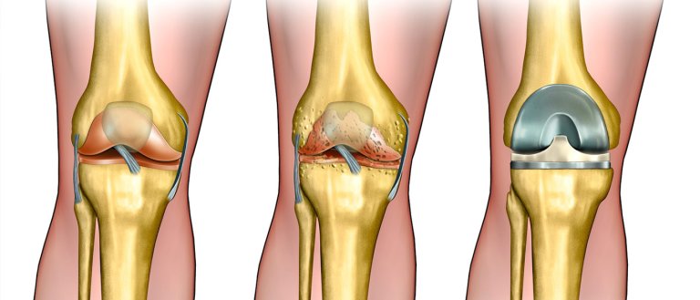 Medical Breakthrough Offers Alternative to Knee Replacement Surgery