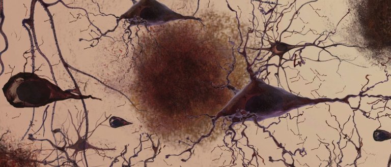 Medicine Shown to Reverse Alzheimer’s in Mice