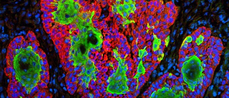 Meet the Pill That Lights up Cancerous Tumors