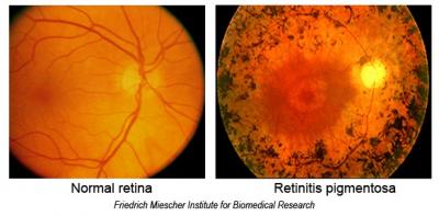 retinitis pigmentosa