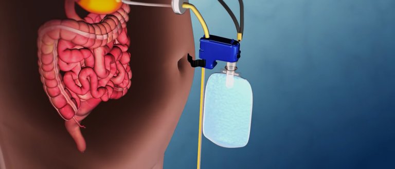 New FDA-Approved Device Sucks Food From Your Stomach Before You Can Digest It
