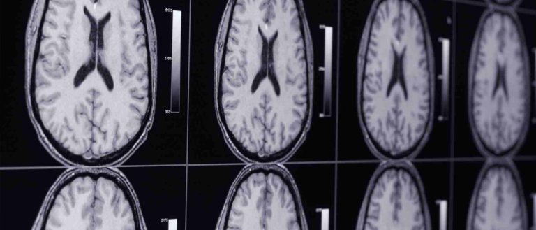 Ultrasound May Open New Avenues For Brain Treatment
