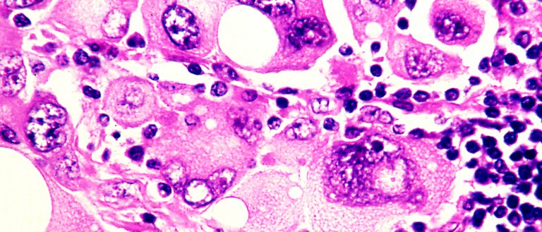 Combination Drug for Melanoma is Now Ready for HS Use