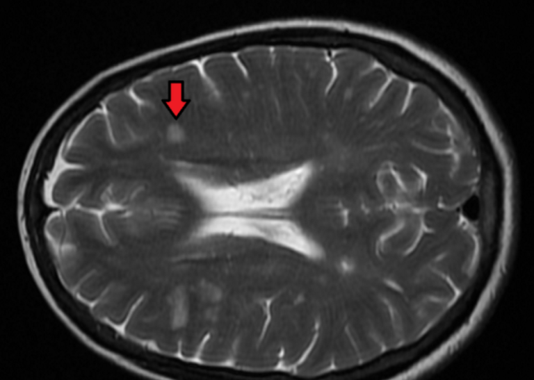 Reversal of Multiple Sclerosis Via Risky Stem Cell Treatment Confirmed