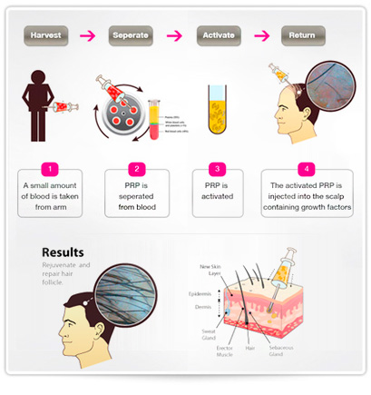 Platelet-rich plasma is also known for other therapeutic purposes. Dr. Mark Bishara, MD.