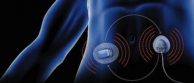 2018 May be the Year of The Artificial Pancreas