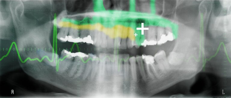 Stem Cell Fillings Allow Teeth to Heal Themselves