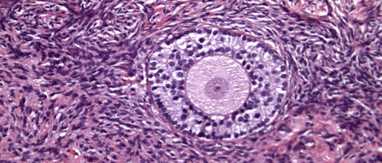 Twin Sisters Try To Get Pregnant With Ovaries That Were Frozen For 7 Years
