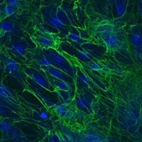 During the natural scarring process, collagen proteins (green) in fibroblasts from a Dupuytren patient crosslink together. (Image source: Iyer Lab)
