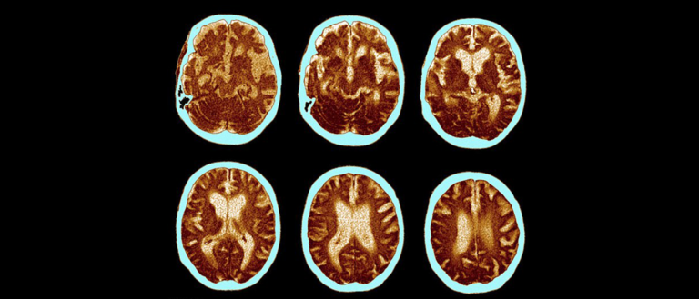 The Fight Against Aging: New Drug Reduces Toxic Proteins Linked to Alzheimer’s