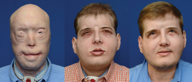One Year Later: Firefighter Describes Life After World’s Most Extensive Transplant