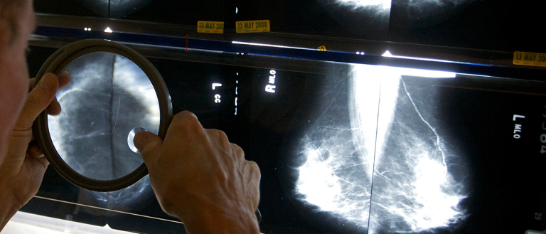 Artificial Intelligence Reads Mammograms With 99% Accuracy