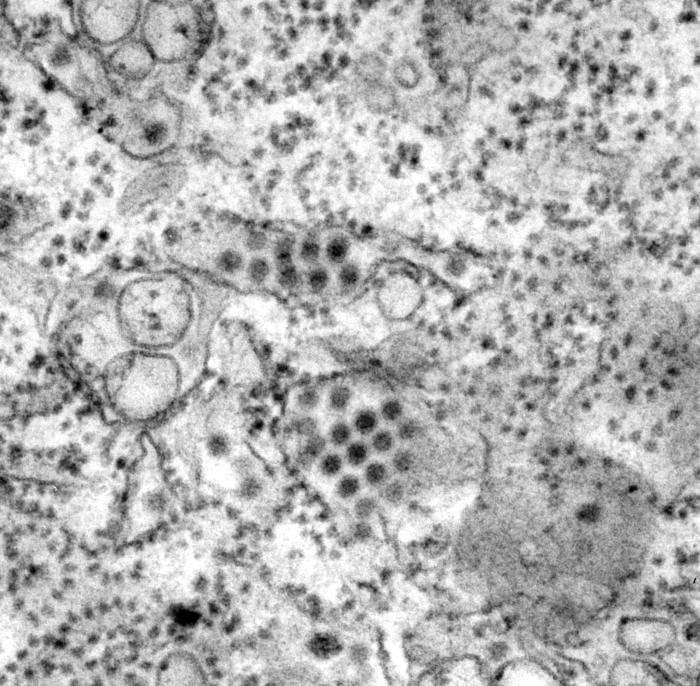 This transmission electron micrograph (TEM) depicts a number of round, Dengue virus particles that were revealed in this tissue specimen. Credits: CDC/ Frederick Murphy