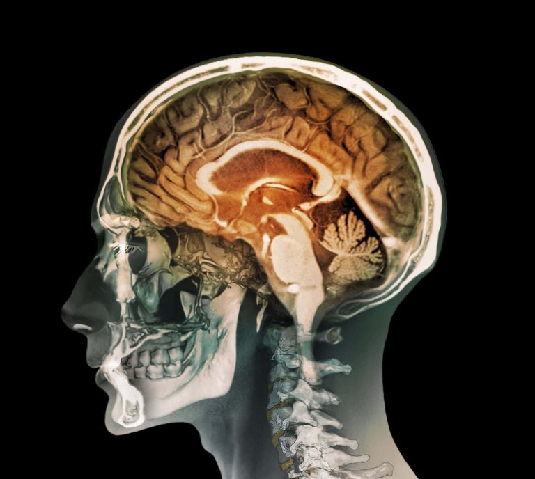 stroke il-1ra brain diseases