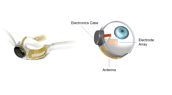 The Argus II, Second Sight's FDA-approved visual prosthetic. Credit: Second Sight