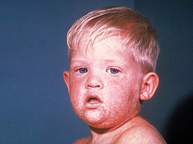 Symptoms of measles include rashes around a victim's body, and a high fever. Death comes in the form of complications due to a weakened immune system. Children are highly susceptible to this because of their underdeveloped immune system. Credit: CDC