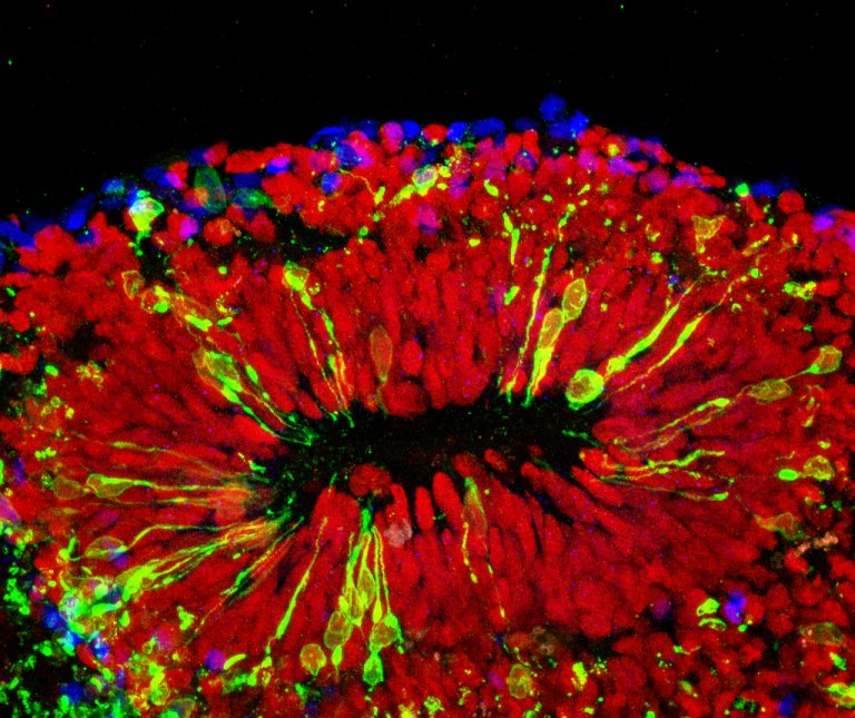 Tiny “Minibrains” Could Revolutionize Medicine